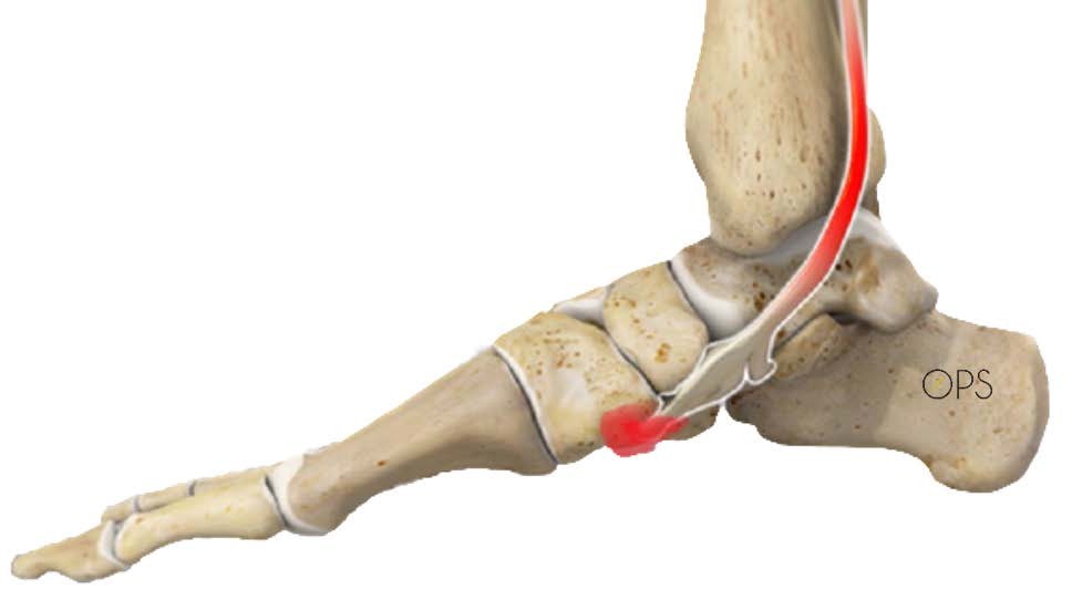 PIED PLAT ET SES TRAITEMENTS semelles orthop diques chirurgie